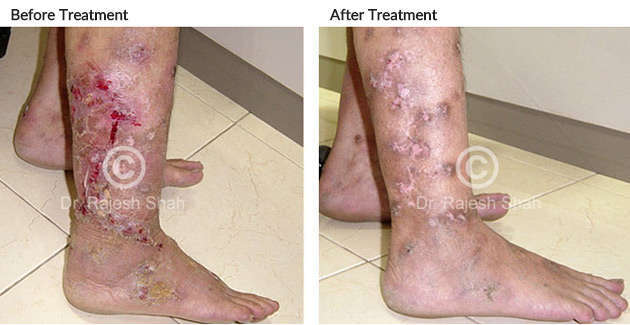 pyoderma legs before and after